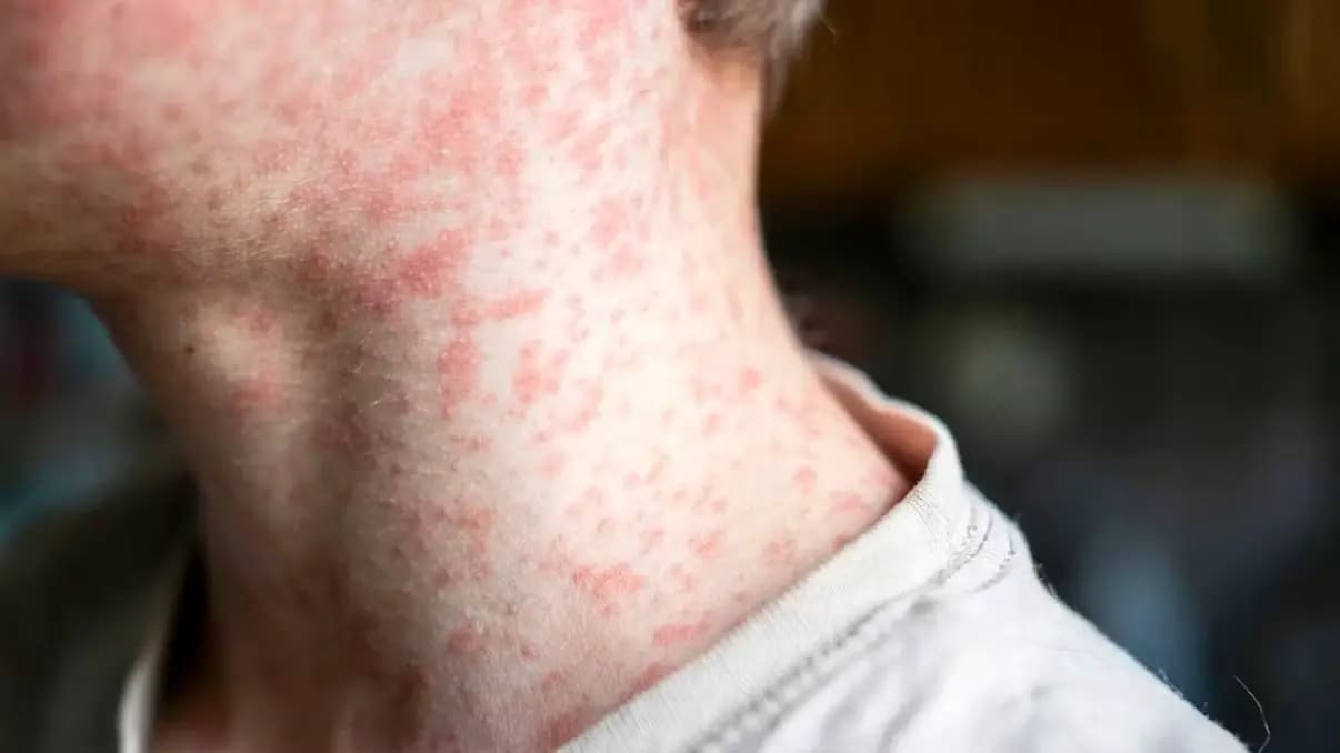 Красный список ВОЗ: Австрия в числе шести стран, где корь снова стала угрозой